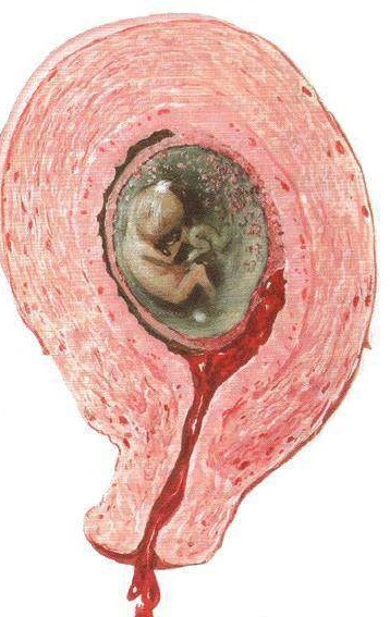 西安无痛人流手术